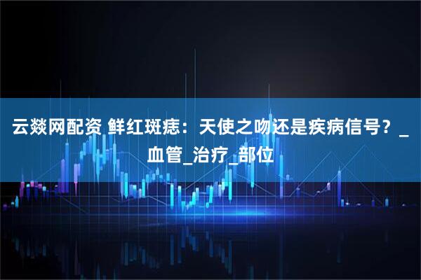 云燚网配资 鲜红斑痣：天使之吻还是疾病信号？_血管_治疗_部位